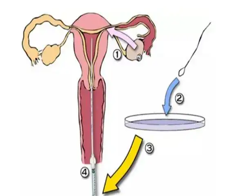 关于早衰 试管代孕中心